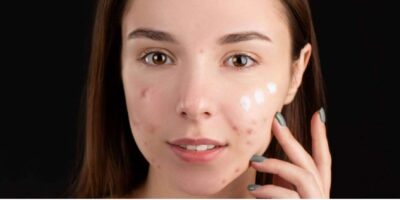 Acne 101: Understanding the Causes and Types of Acne
