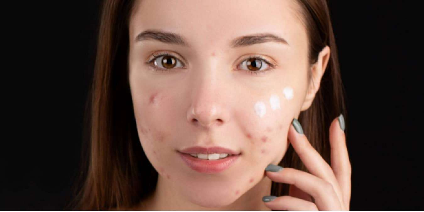 Acne 101 Types Of Acne Featured