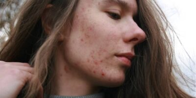 Acne and Mental Health: How to Cope with the Emotional Impact of Acne